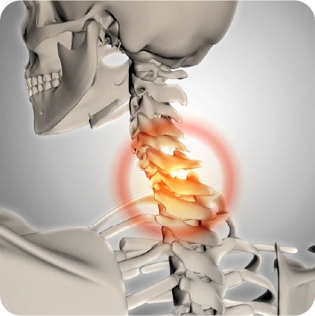 Tratamiento para el dolor por hernia cervical con quiropráctico en Veracruz
