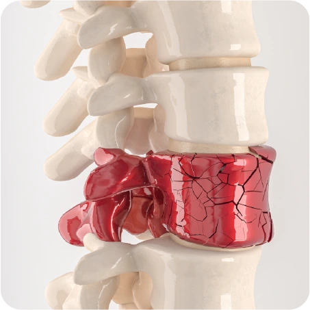Tratamiento para el dolor por hernia intervertebral con quiropráctico en Veracruz