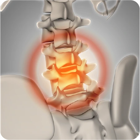Tratamiento para el dolor por hernia lumbar con quiropráctico en Veracruz