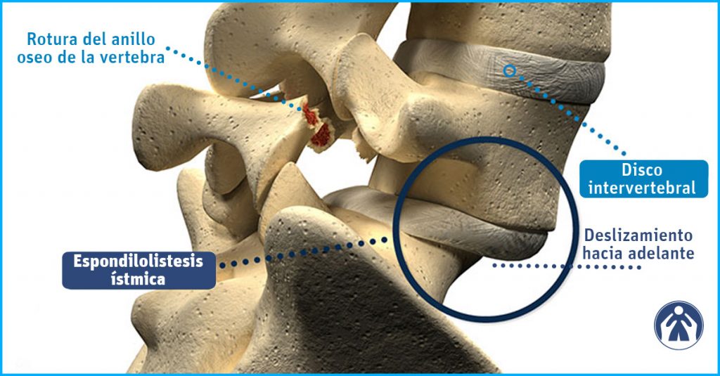 ¿Se puede tener una fractura en la columna sin saberlo? | Centro